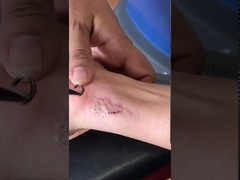 Y6 Powerfull Q Switch Nd Yag Laser Perangkat Penghilang Tato Efektif