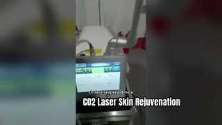 30W আরএফ টিউব ফ্যাকশনাল সিও 2 লেজার দাগ অপসারণের জন্য ত্বকের টান